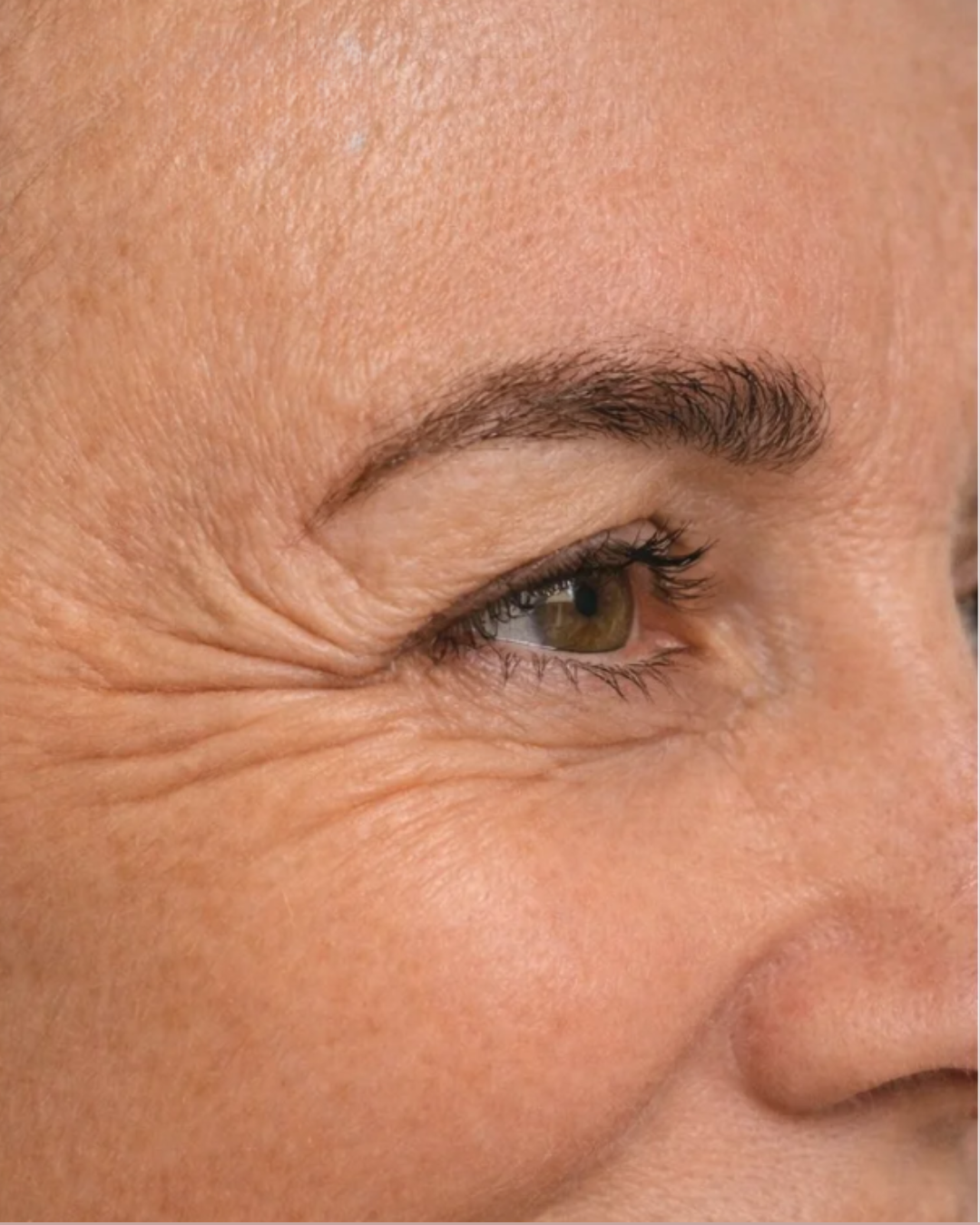 Antes do procedimento de botox