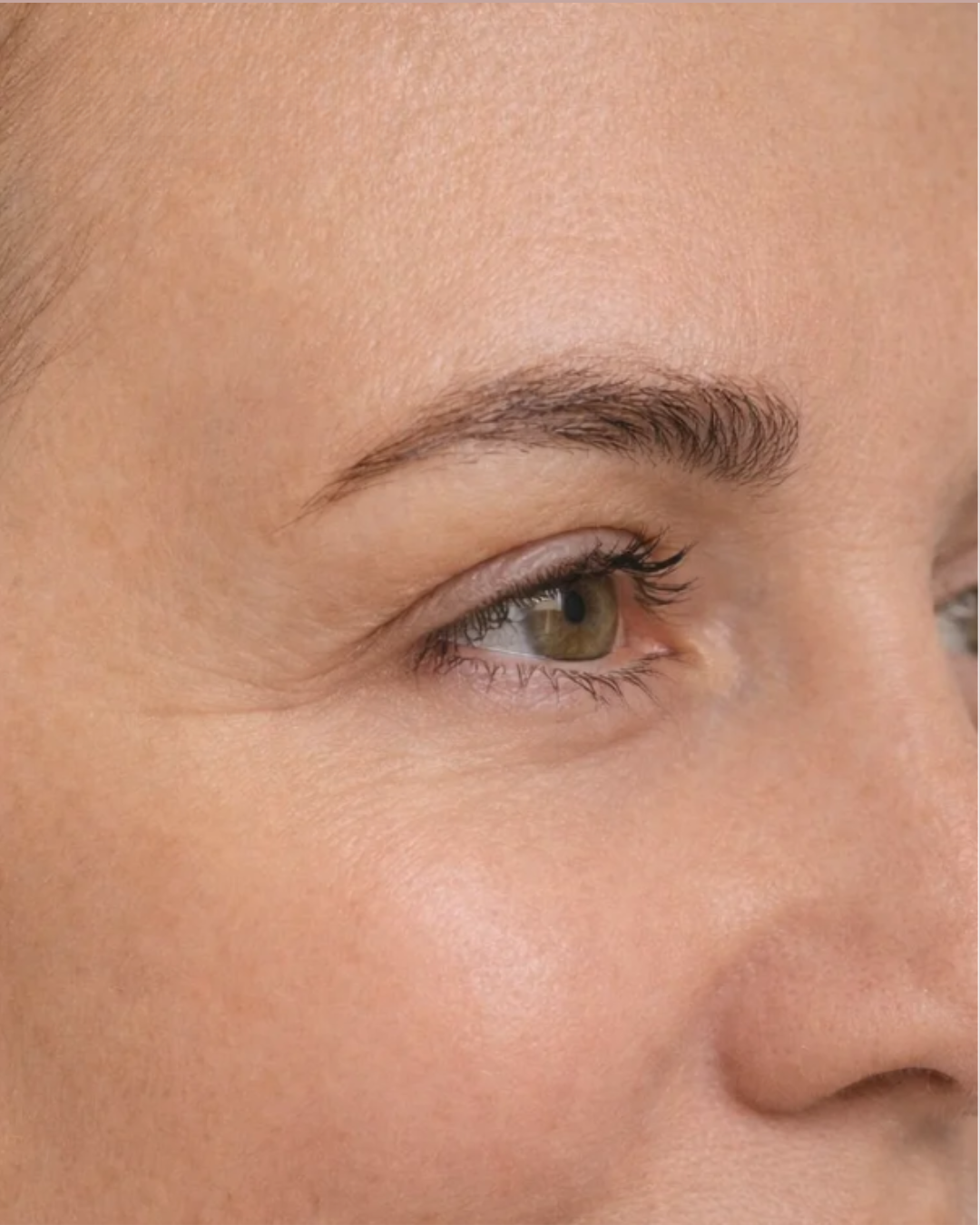 Depois do procedimento de botox